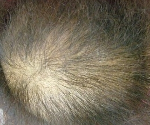 항암 부작용으로 인한 탈모 상태