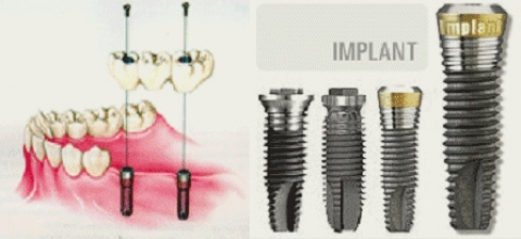 임플란트, 시술 후 관리가 더 중요한 이유