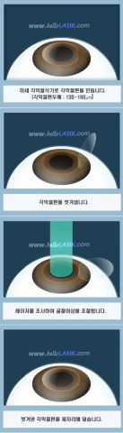 라식수술과정