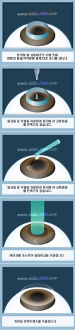라섹수술과정