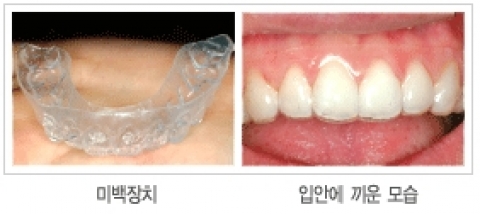 치아 미백에 관한 일문일답