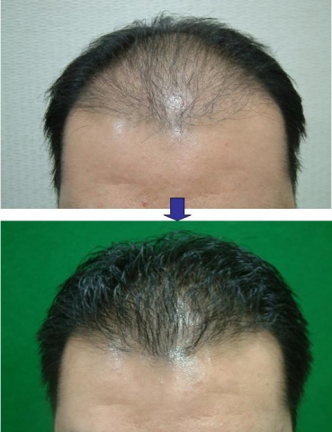모발이식 수술 전후 비교
