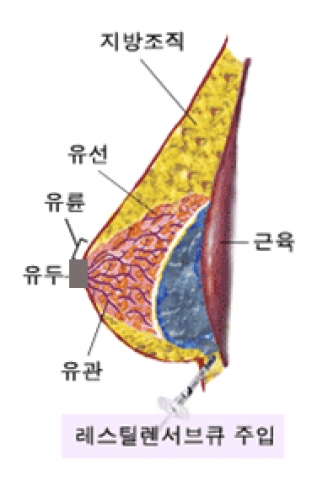 필러가 주입되는 시술 부위