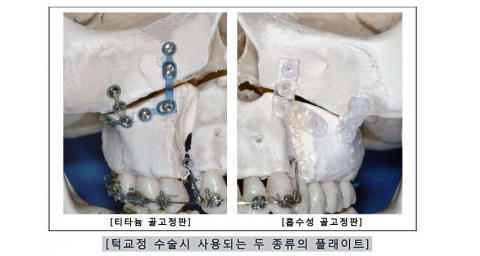 턱교정 수술시 사용되는 두 종류의 플래이트