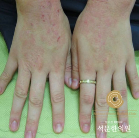 아토피·알레르기 체질의 공통적인 특징있어...근본원인을 치료해야