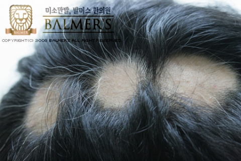 10대 수험생 탈모, 단순 원형탈모 이상이면 전문가 상담 필요