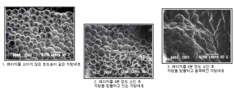 레이저를 쏘인 후의 지방세포들의 변화