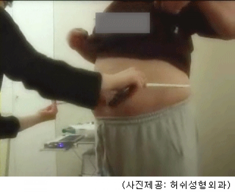 복부비만, 나이들어 보여 콤플렉스…매일 1시간 가량 빠른 걸음 도움