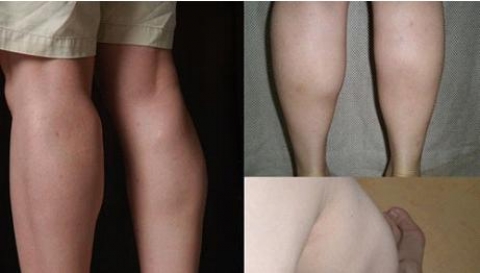 패션을 완성하기 위한 ‘종아리 성형’ 까치발·O자형 등 부작용도 많아