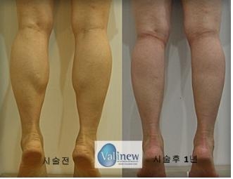 종아리성형, 달리기·점프능력 저하 피할 수 없어
