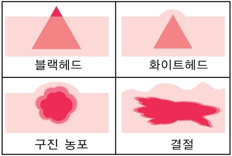 여드름의 종류-화접몽한의원 조사
