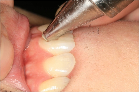 그림 3,4. 치아외부에 초음파 프로브를 접촉하여 치수의 혈류를 그림 우측(4번 그림)에 나와 있는 바와 같이 측정할 수 있다. 심장의 이완 및 수축에 따라 혈류 속도가 변동됨을 확인할 수 있으며, 치수의 생활력에 손상을 입은 치아의 경우 이러한 혈류의 속도가 매우 낮음을 확인할 수 있다. 이와 같이 치아의 혈류 속도를 비침습적으로 측정함으로써, 치아의 보존 치료의 방법을 정확하게 결정할 수 있으며, 치료 경과도 지속적으로 모니터링할 수 있다.