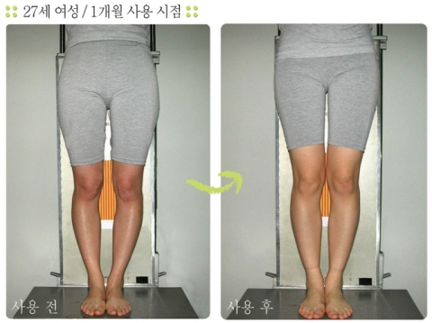 스타일렉스 치료결과