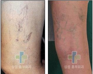 ‘하지정맥류’를 판단하는 7가지 기준