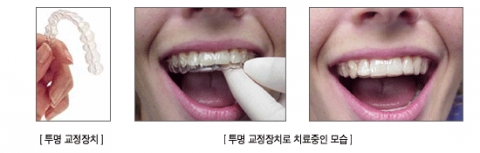 티 안나게 이뻐지는 치아투명교정