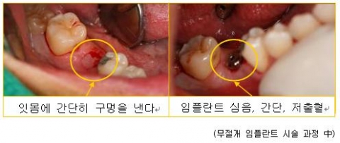 무절개임플란트 시술과정