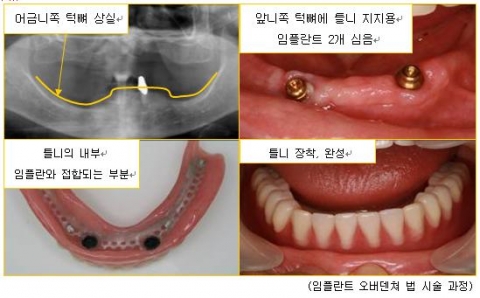 임플란트오버덴쳐법 시술 과정 이미지