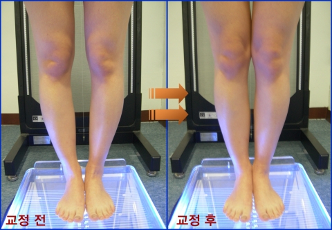휜다리 교정 전후 모습