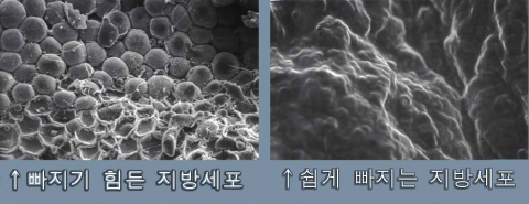 운동 다이어트를 쉽게 하는 방법 : HPL지방분해주사를 이용해 운동시에 지방세포가 빠지기 쉽게 만들어준다.