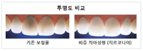 베버리힐스치과, ‘초단기 치아성형’ 시술 시행