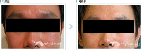 안면홍조 치료전후