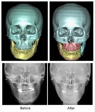 3D CT(3차원 영상분석)는 입체적인 측정을 통해 얼굴의 외부뿐만 아니라 얼굴 내부 뼈의 해부학적 구조와 뼈의 두께까지 파악 가능하다