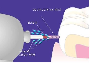 물방울레이저 2