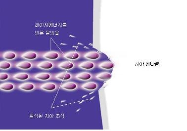 물방울레이저 3