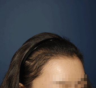 헤어라인 성형 후
