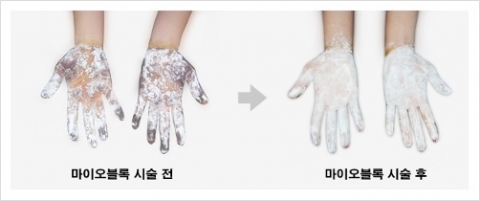 휴앤미성형외과, 마이오 블록 이용 부작용 없이 간단하고 효과적인 다한증 치료