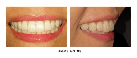 “투명교정으로 2010년 즐겁게 웃고 재산도 지키자”