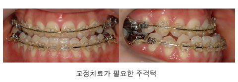 “주걱턱 교정치료 빠를수록 좋다…성장완료 후엔 턱수술 동반해야”