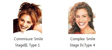좌측의 미소는 윗니만 보이는 미소이며, 자연스러운 미소이기에 Commisure Smile이자, Stage III의 Type1의 미소이지만, 우측은 환하게 웃으면서 아랫니도 동시에 