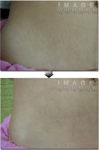 튼살치료 전후 사례