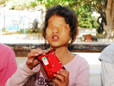 올해 열살의 어린 소녀 '달롱(Dal Long)' 이다. 힘들고 고통스러워도 눈물을 흘릴 수 없는 얼굴을 가진 선천성 시각장애우다.