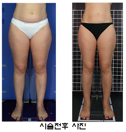 하체비만 극복에 도움이 되는 소닉스타 스키니 시술 전후