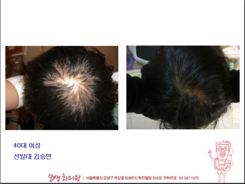 모생c 메인페이지 탈모사진 비교