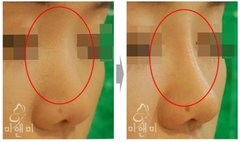 쁘띠성형 시술 전/후