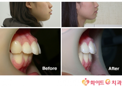 ‘돌출입교정’, 정확한 진단과 치료방법으로 치료 가능