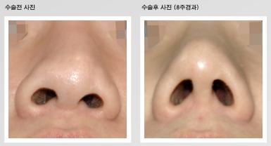 비개방형 코끝성형 후 콧기둥에 절개흉터가 전혀 보이지 않는 모습(사진제공: DK성형외과)