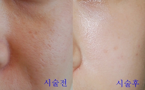 나는 새해에 한살 덜 먹는다…젊고 아름다운 피부를 가진 동안(童顔) 만들기