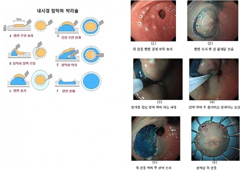 내시경 점막하 박리술