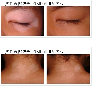 백반증 치료 전후사진