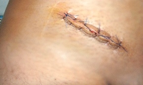 타의료기관의 절개법 수술후 심한 상처사진