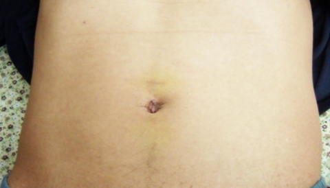 단일구멍 담낭절제술후 7일째 모습