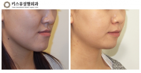 키스유성형외과 양악수술 전후 사진