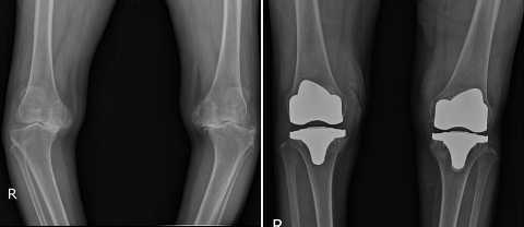 관절염 수술 전과 수술 후