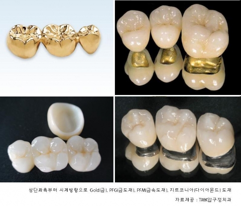 어금니 보철물 재료의 비교