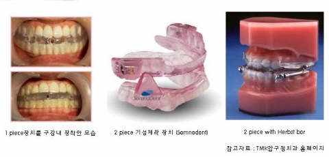 TMK압구정치과에서 선택가능한 코골이장치의 종류