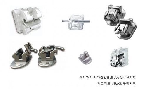 티엠케이 압구정치과에서 사용중인 여러가지 자가결찰브라켓